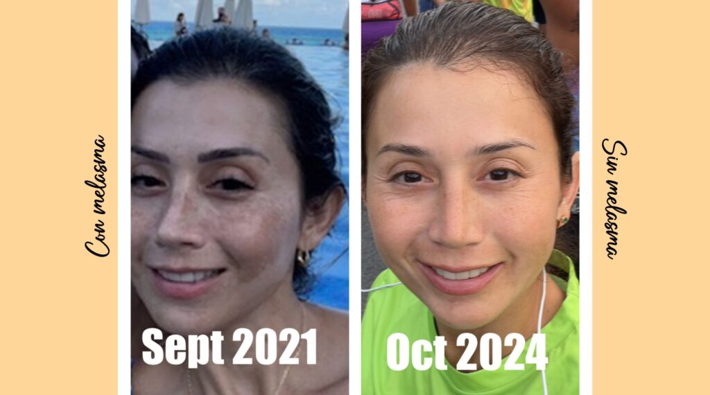 reducción de melasma - tualimentoesencial